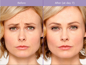 Injectable Before and After